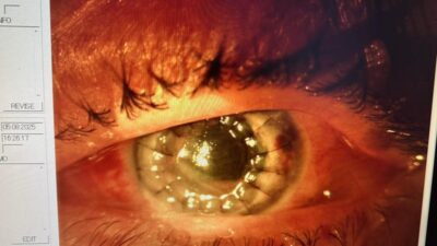 Erzincan Mengücek Gazi Eğitim ve Araştırma Hastanesi Göz Hastalıkları Anabilim