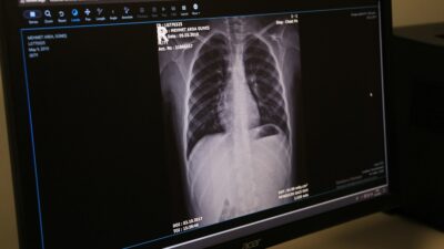 1-30 Kasım Akciğer Kanseri Farkındalık Ayı dolayısıyla Erzincan İl Sağlık