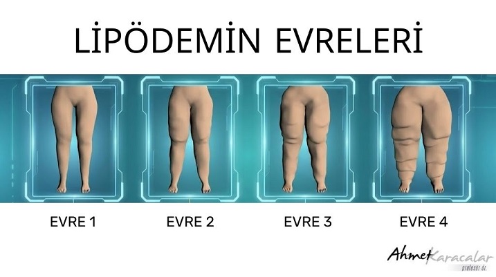 Prof. Dr. Ahmet Karacalar Uyardı: bu bir obezite değil, ilkel